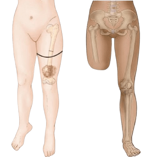 Amputation- Above Knee