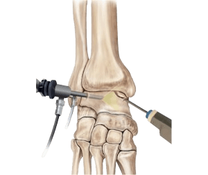 Ankle Arthroscopy