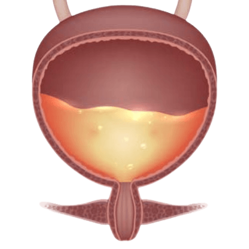 Bladder Instillation