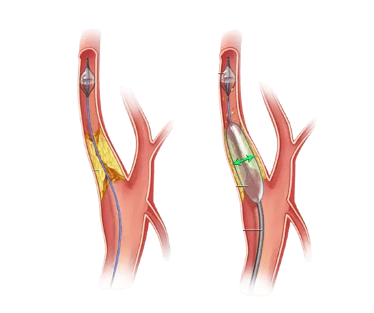 Carotid Angioplasty