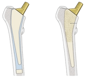 Cemented Total Hip Replacement