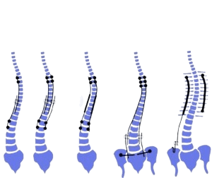 Early Onset Scoliosis Surgery