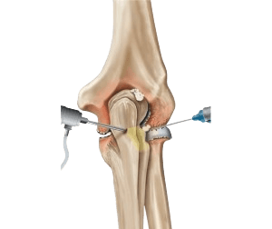 Elbow Arthroscopy