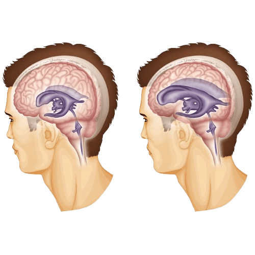 Hydrocephalus