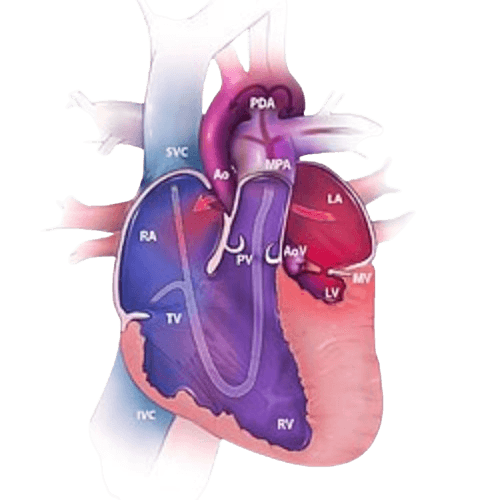 Hypoplastic Left Heart Syndrome (HLHS)