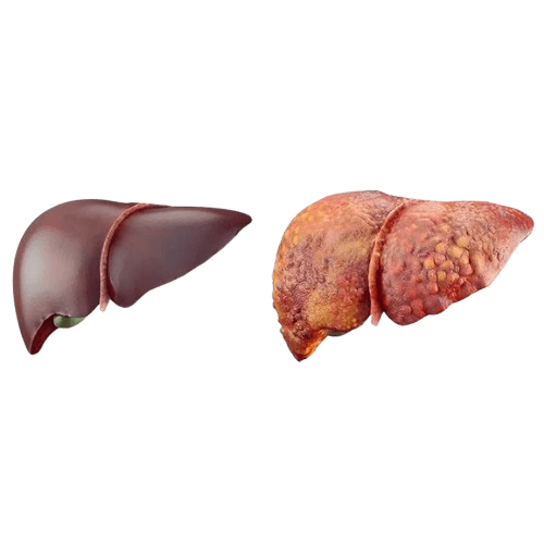 Liver Cirrhosis
