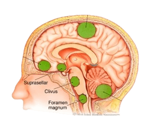 Meningioma