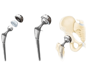 Partial Hip Replacement Surgery - Unilateral Hip Replacement