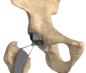 Partial Hip Replacement Surgery