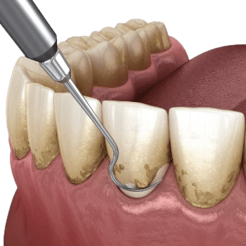 Scaling & Root Planing