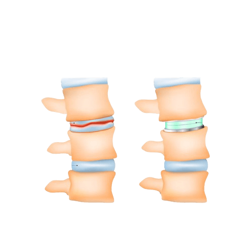 Spinal Disc Replacement