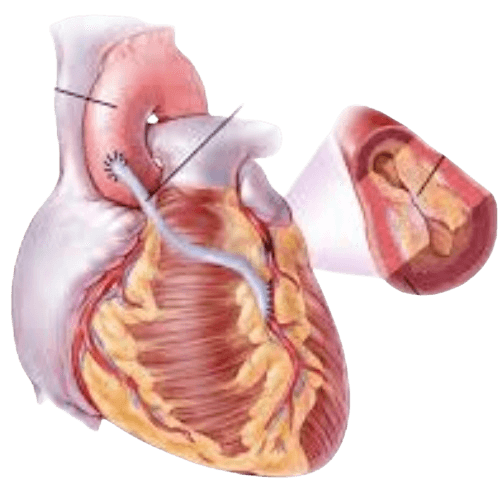 Thallium Test- Nuclear Stress Test