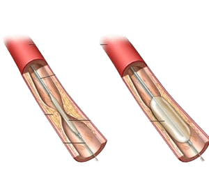 Angioplasty and Stent Placement