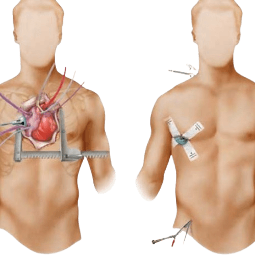 Mitral Valve Replacement