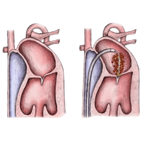 Percutaneous Transvenous Mitral Commissurotomy-PTMC