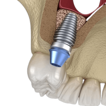 Sinus Lift Surgery - Sinus Augmentation
